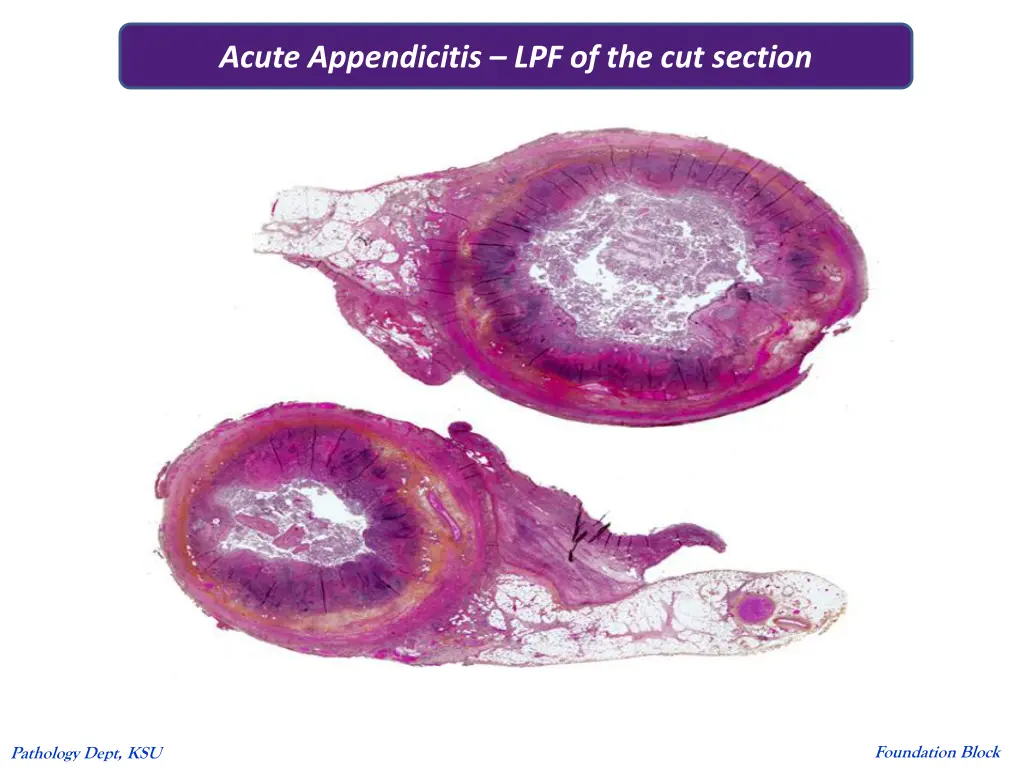 acute appendicitis lpf of the cut section