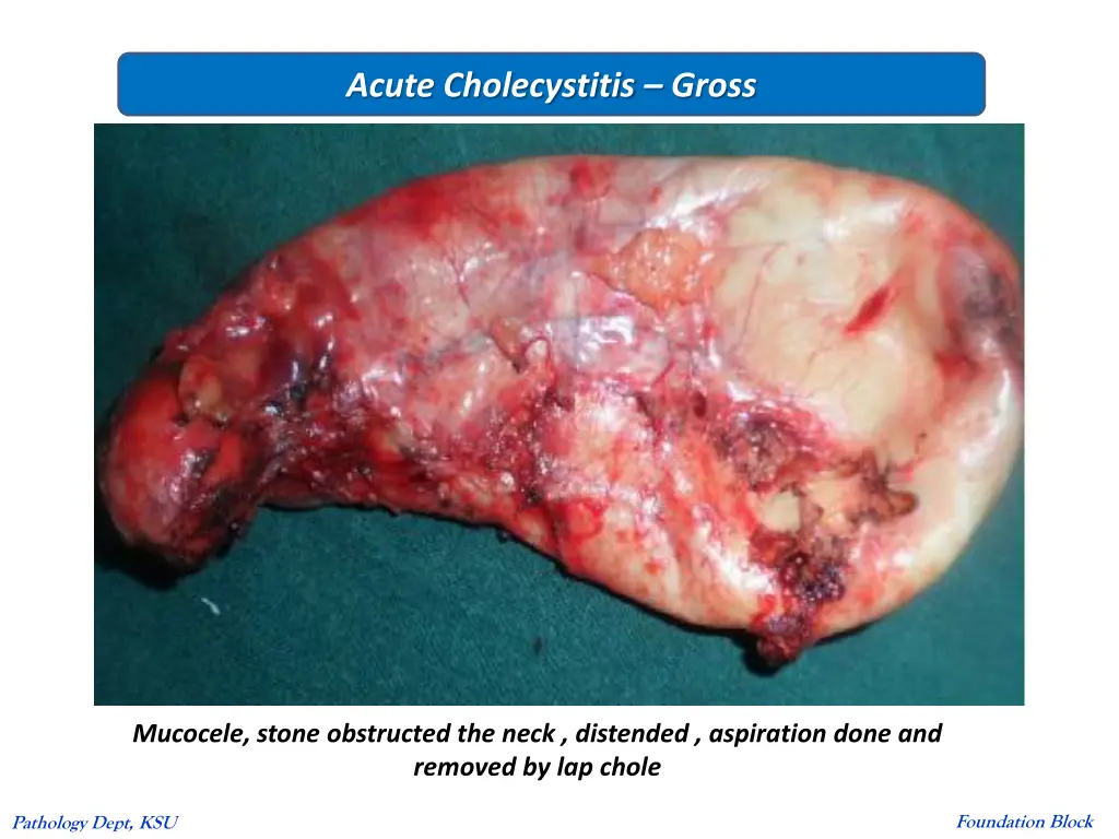 acute cholecystitis gross