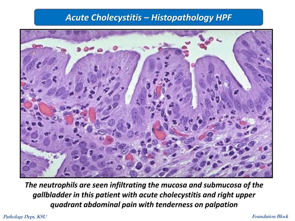 acute cholecystitis histopathology hpf