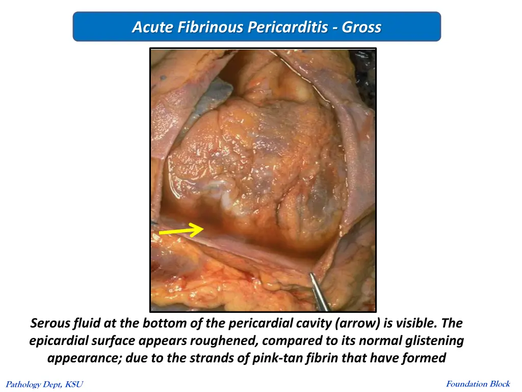 acute fibrinous pericarditis gross 1