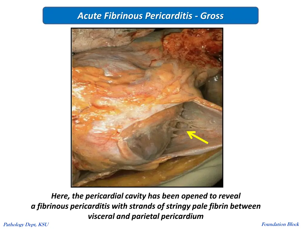 acute fibrinous pericarditis gross