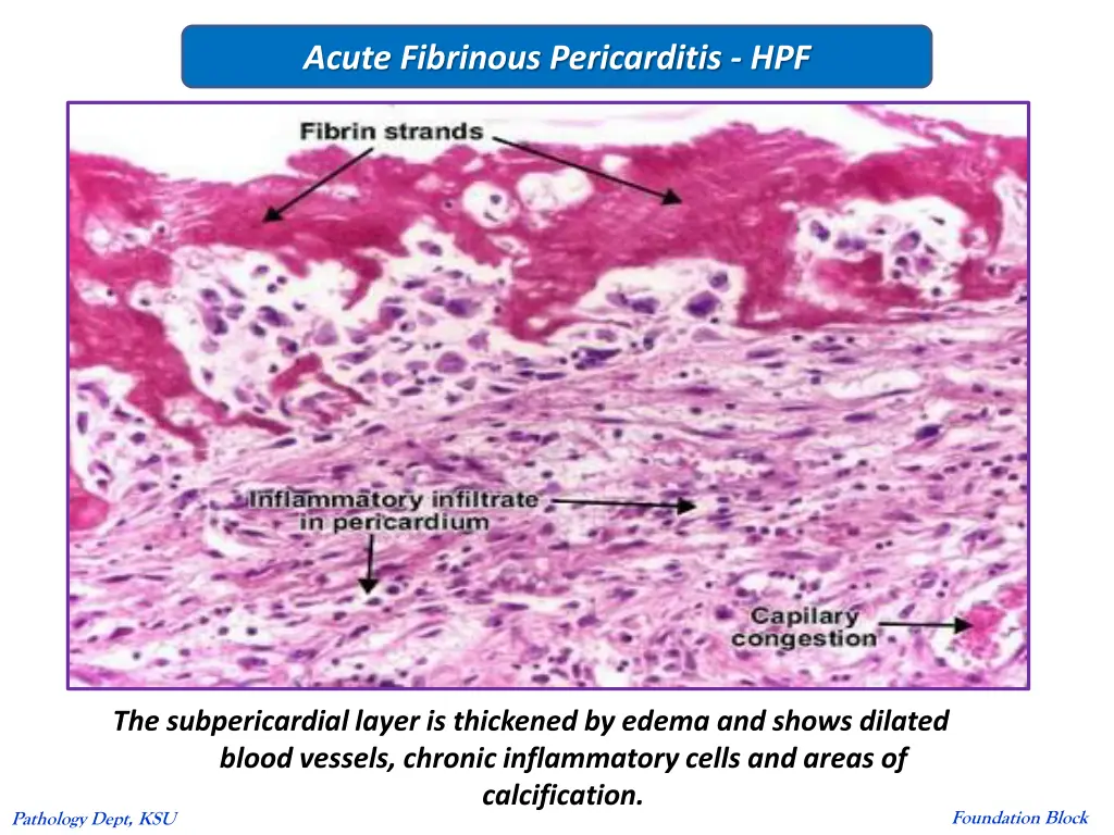 acute fibrinous pericarditis hpf