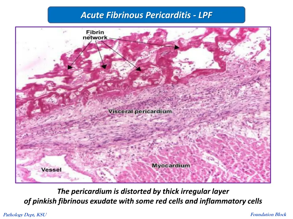 acute fibrinous pericarditis lpf