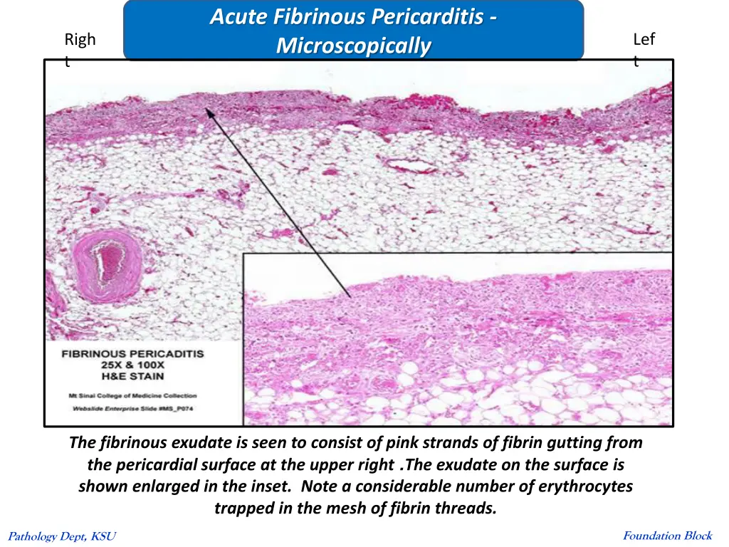 acute fibrinous pericarditis microscopically
