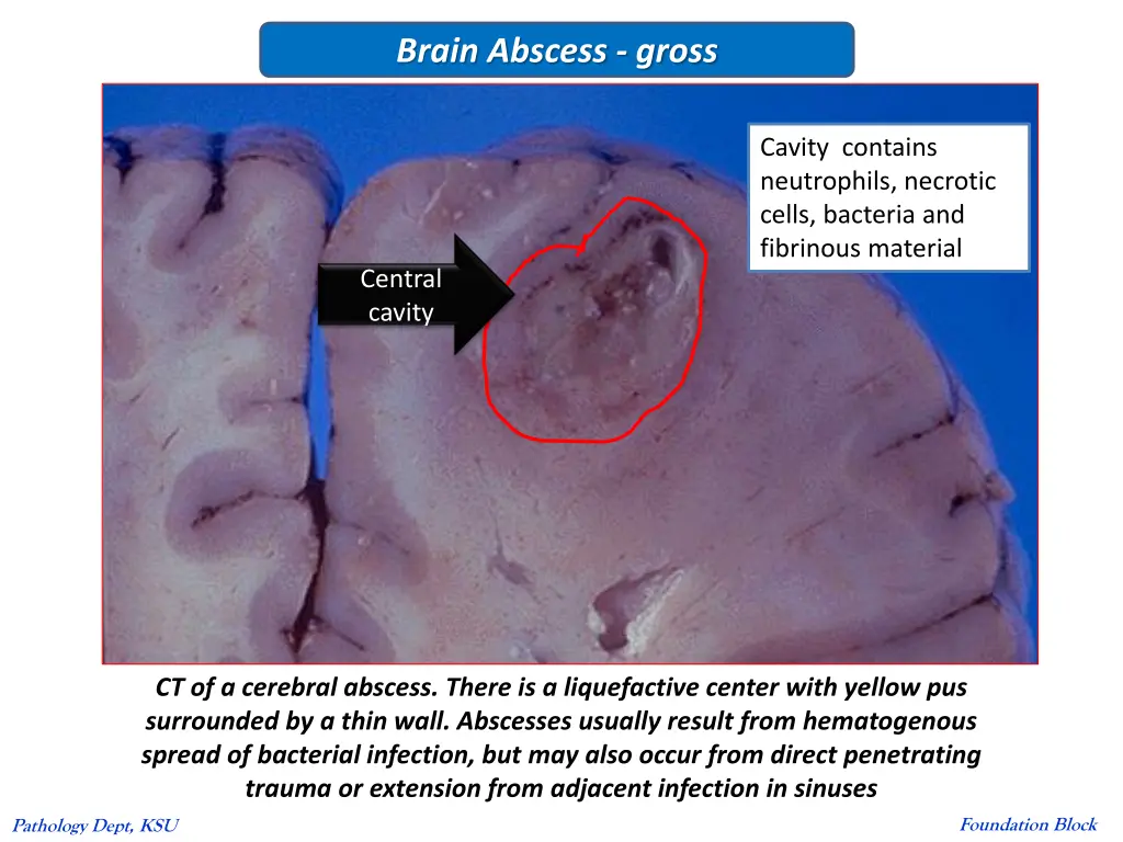 brain abscess gross