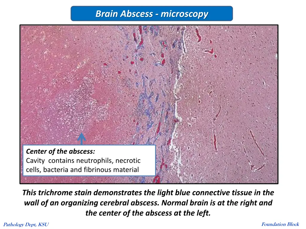brain abscess microscopy