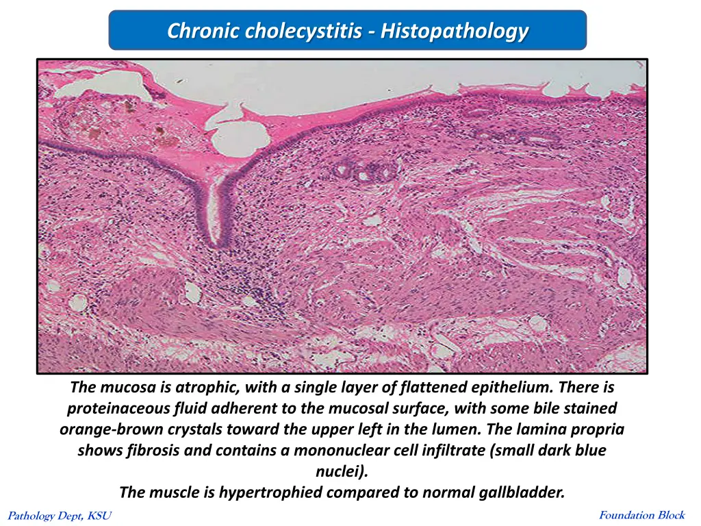 chronic cholecystitis histopathology 1