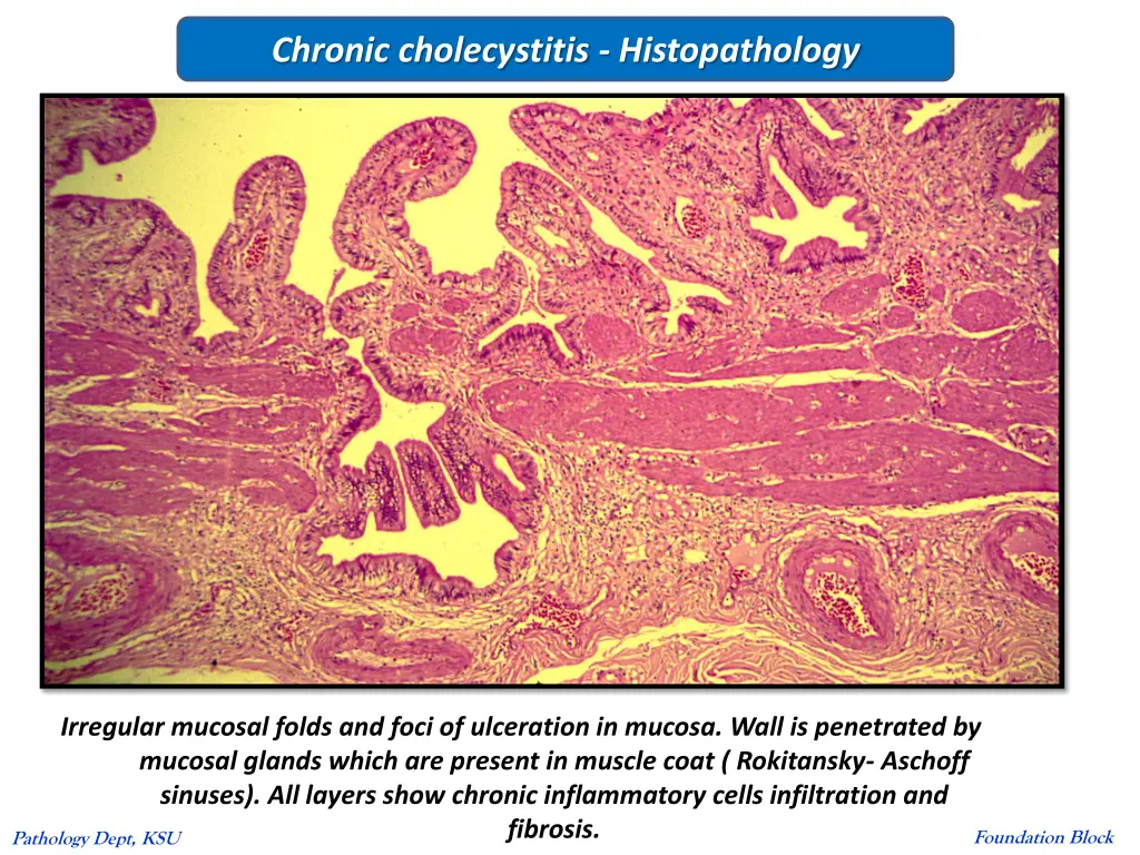 chronic cholecystitis histopathology
