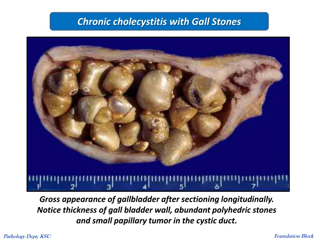 chronic cholecystitis with gall stones