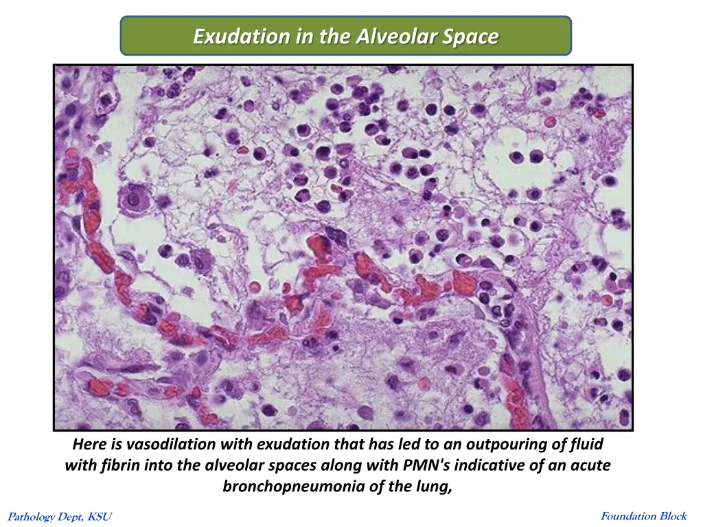exudation in the alveolar space
