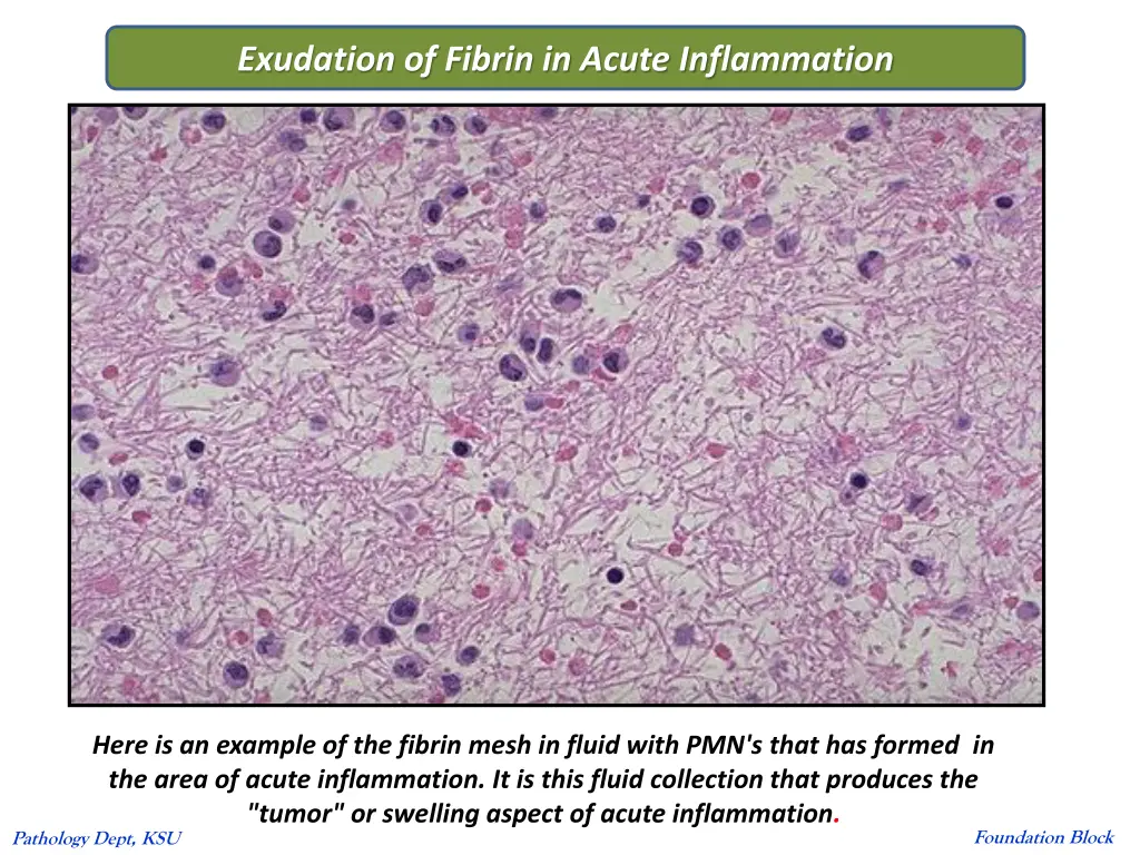 exudation of fibrin in acute inflammation