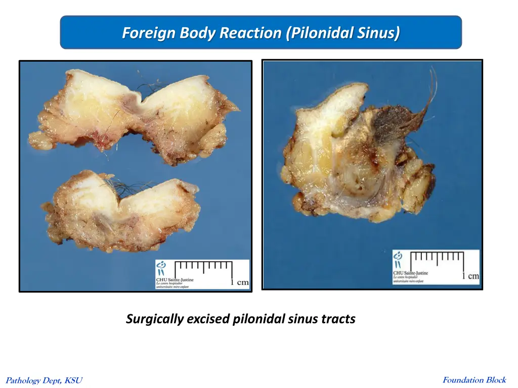 foreign body reaction pilonidal sinus 1