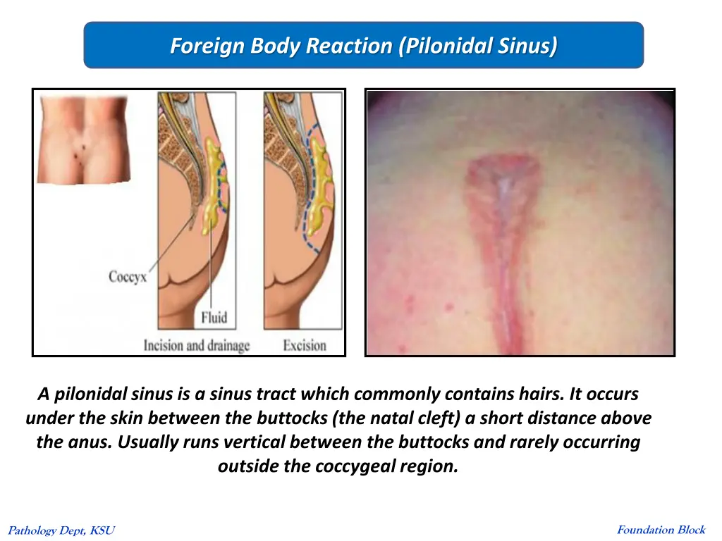 foreign body reaction pilonidal sinus
