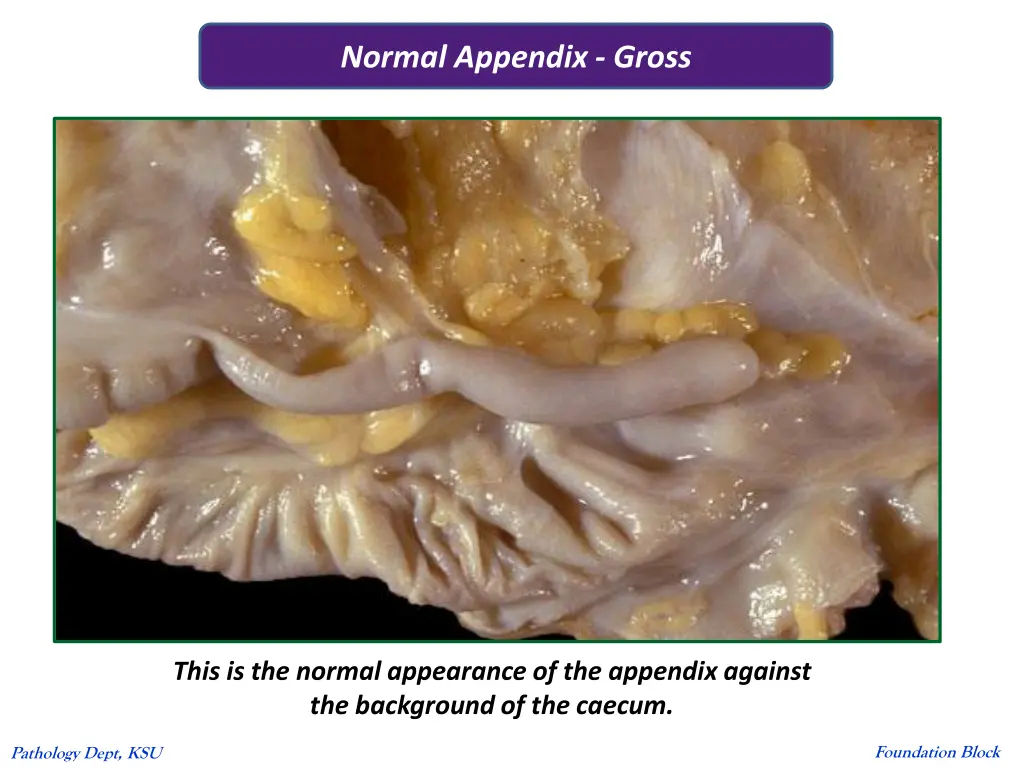 normal appendix gross