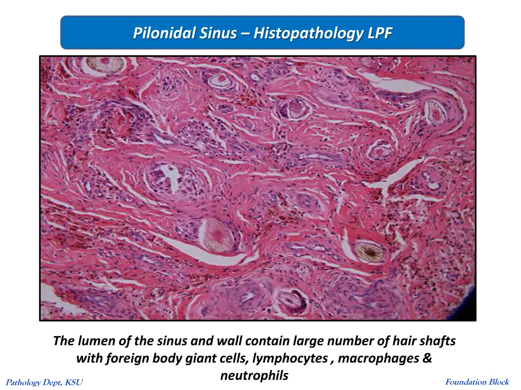 pilonidal sinus histopathology lpf