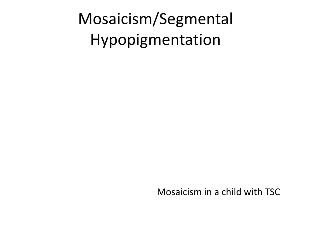 mosaicism segmental hypopigmentation