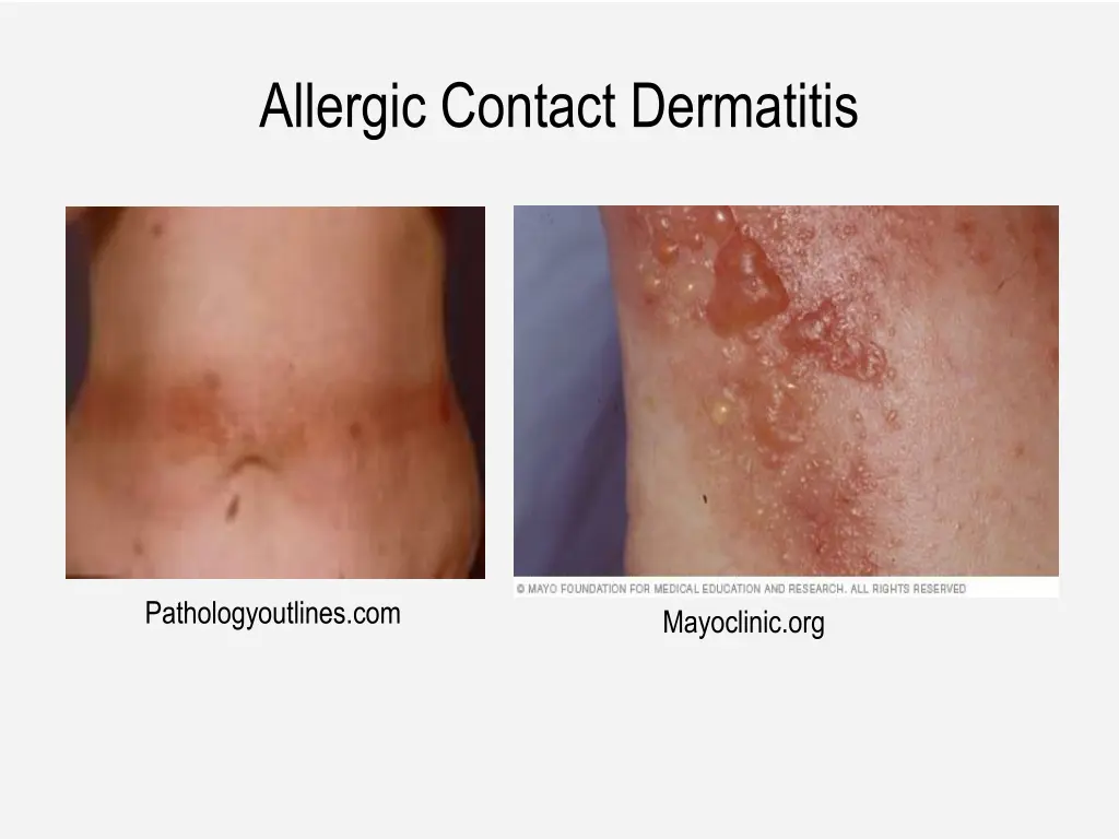 allergic contact dermatitis 2