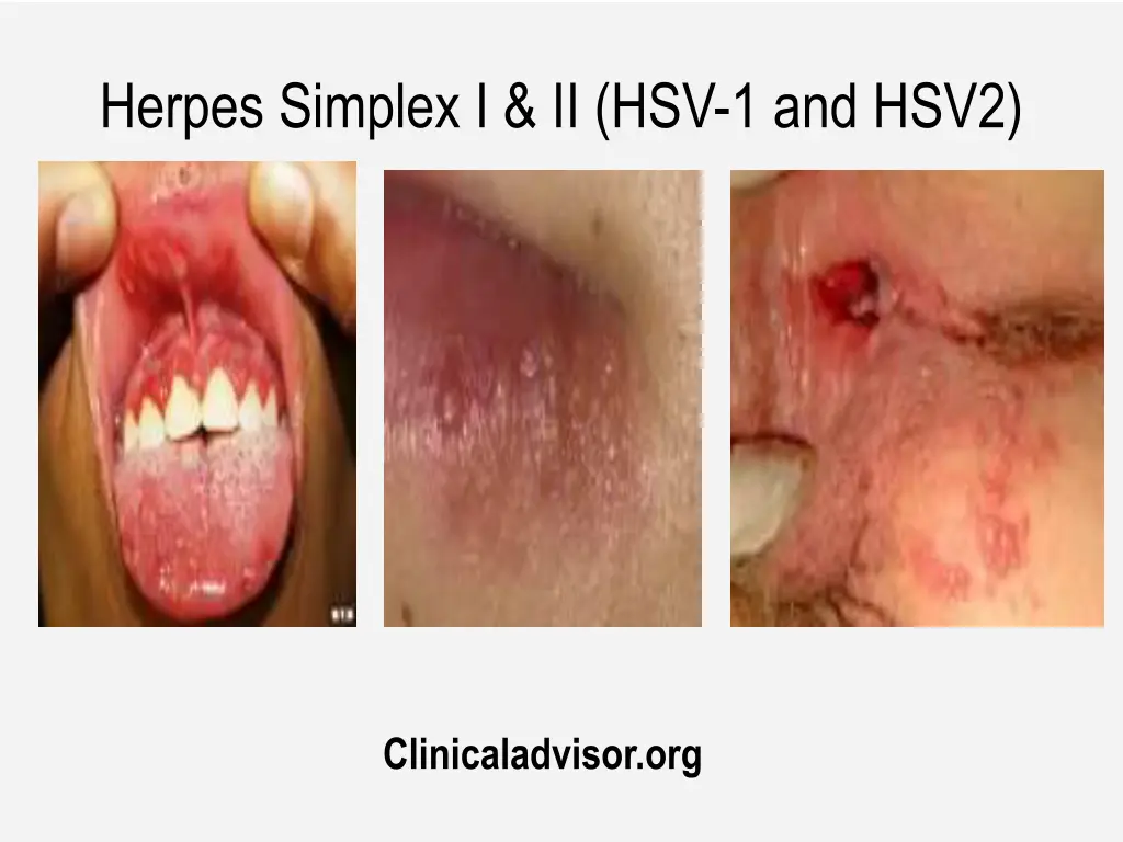 herpes simplex i ii hsv 1 and hsv2