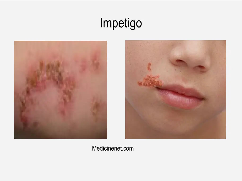 impetigo 1