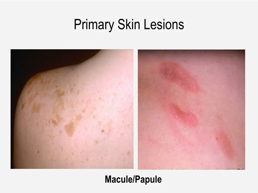 primary skin lesions 1