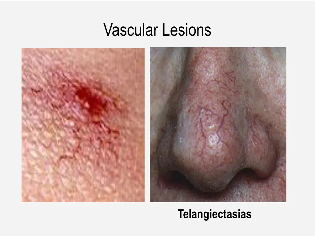vascular lesions