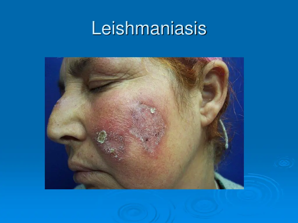 leishmaniasis
