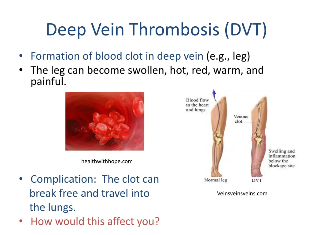 deep vein thrombosis dvt