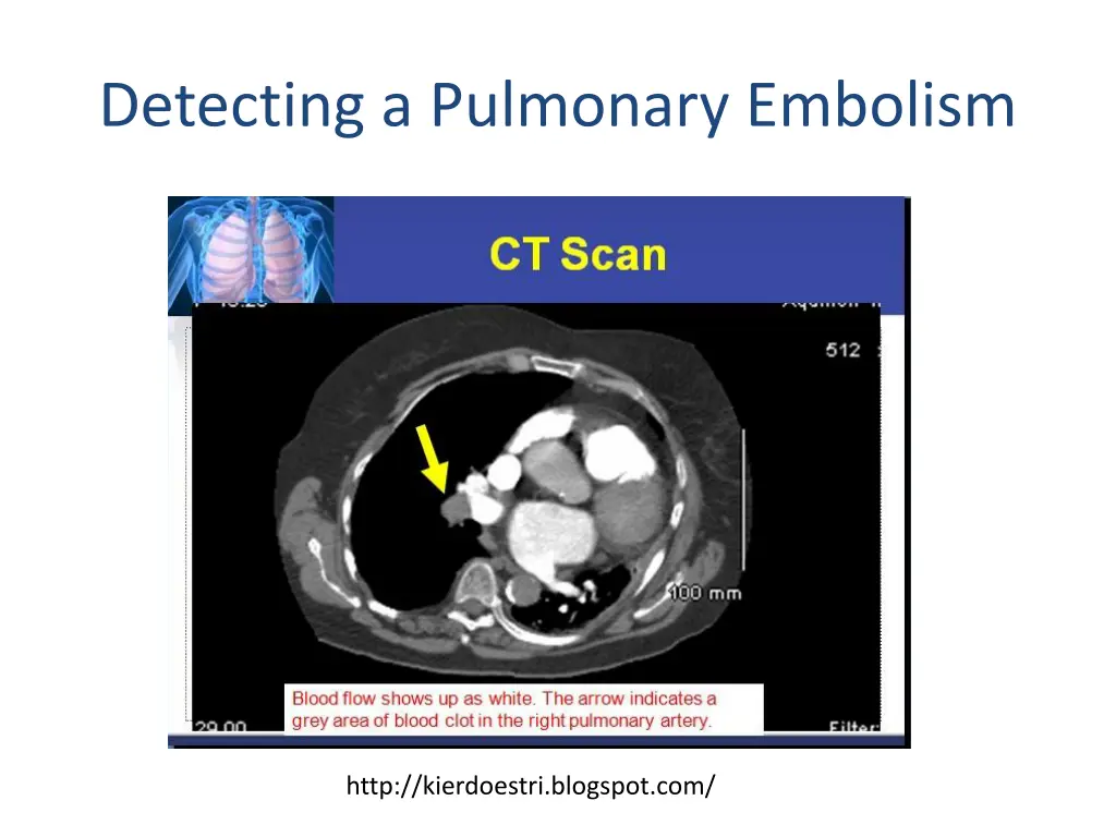 detecting a pulmonary embolism