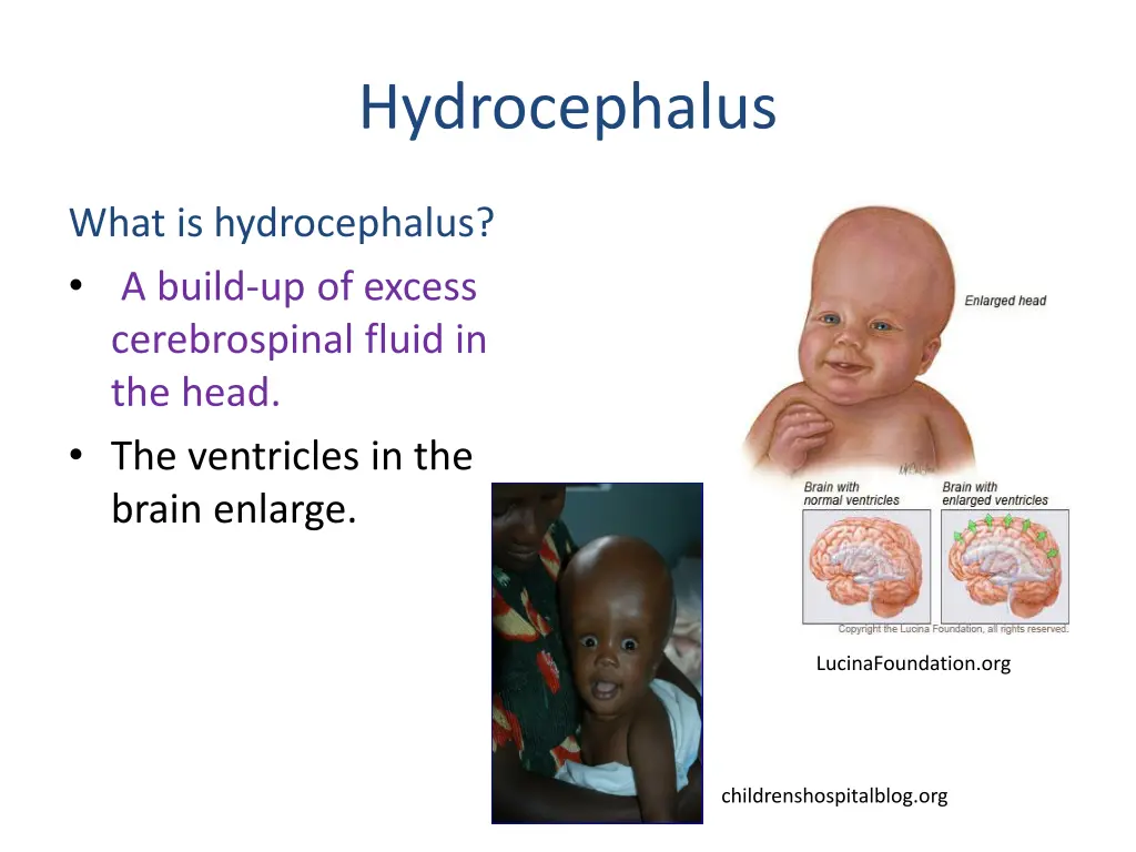 hydrocephalus 1