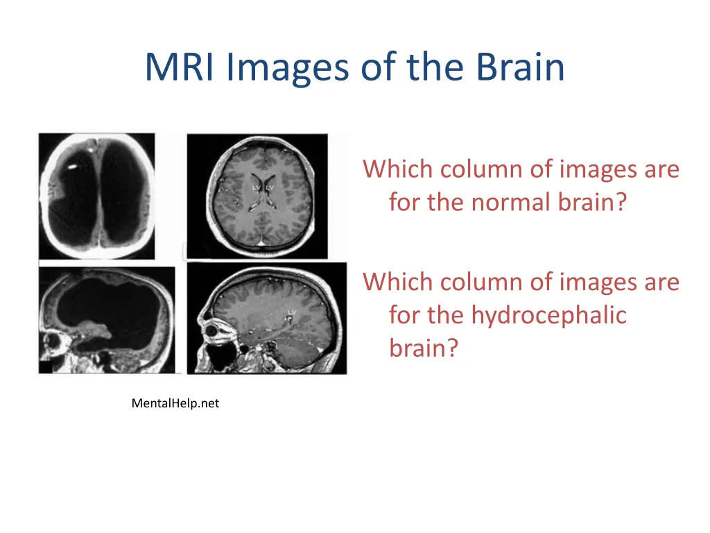 mri images of the brain