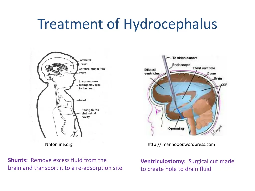 treatment of hydrocephalus
