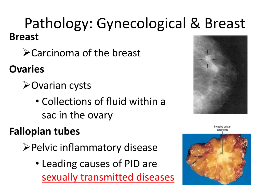 pathology gynecological breast breast carcinoma