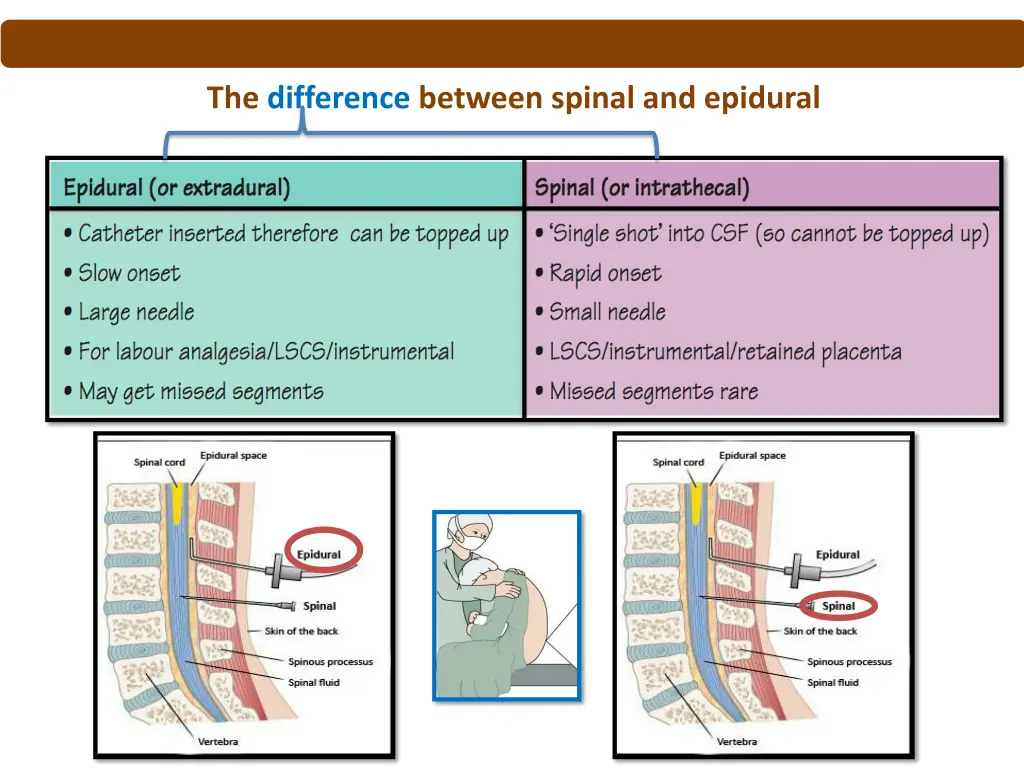 the difference between spinal and epidural
