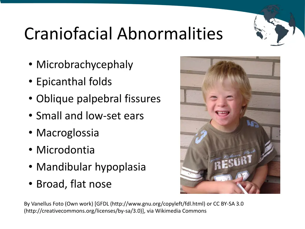 craniofacial abnormalities