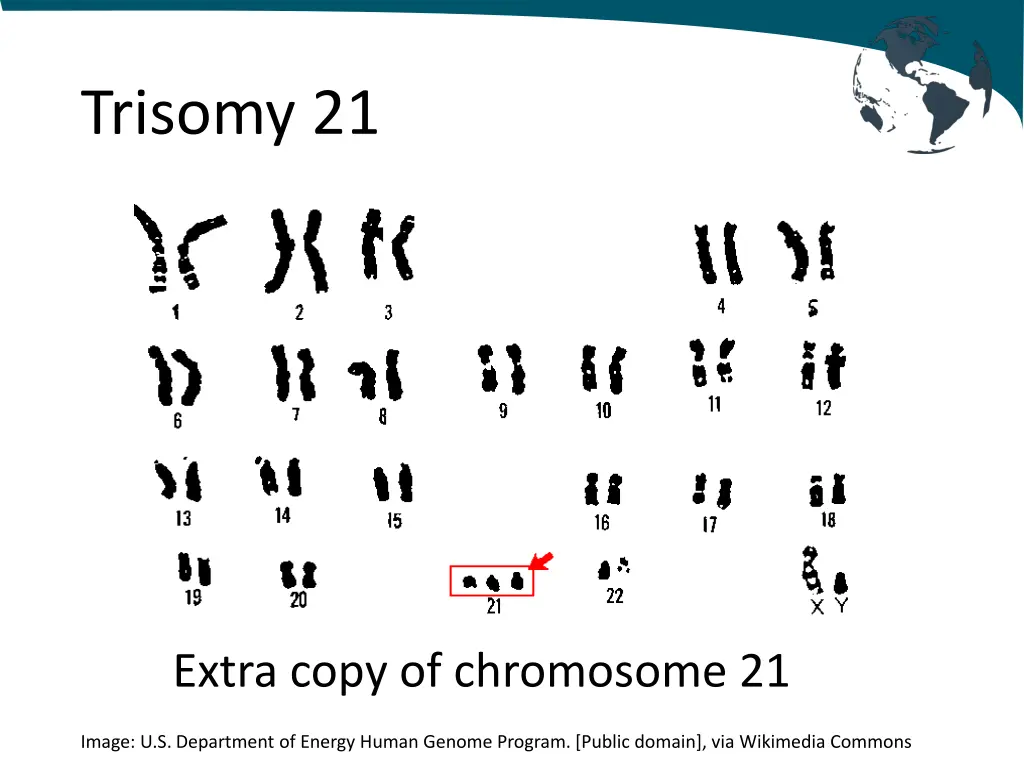 trisomy 21