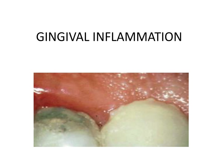 gingival inflammation