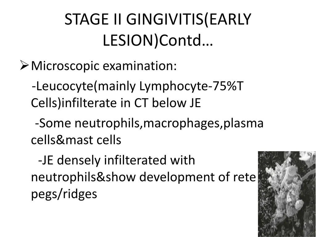 stage ii gingivitis early lesion contd