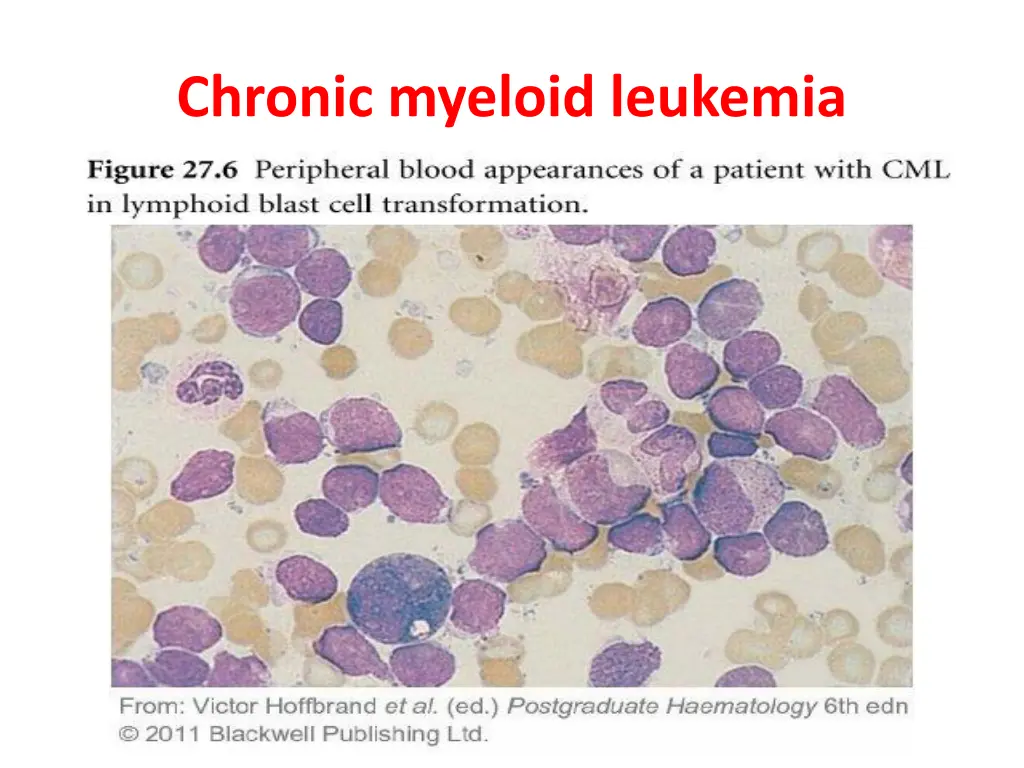 chronic myeloid leukemia 10