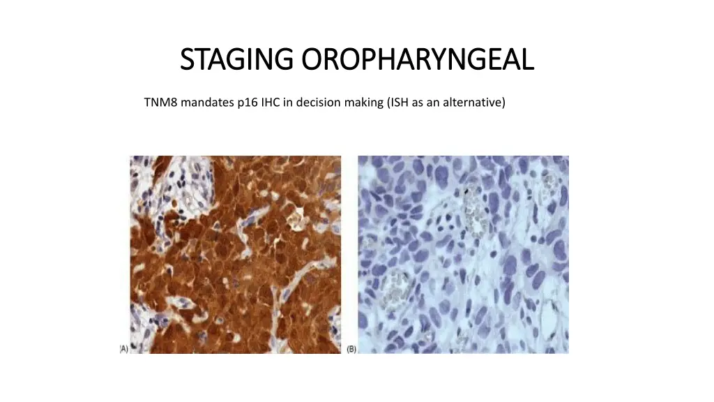 staging oropharyngeal staging oropharyngeal