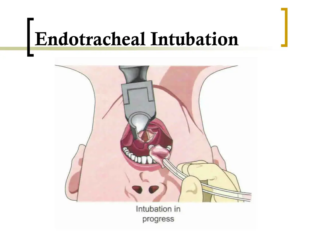 endotracheal intubation