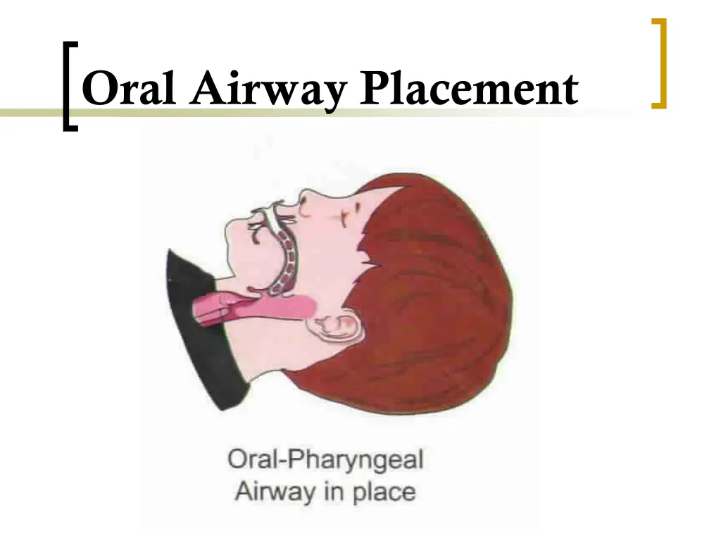 oral airway placement