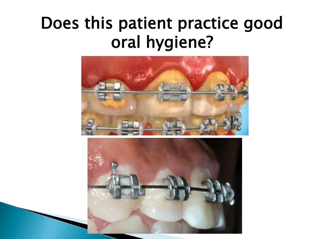 does this patient practice good oral hygiene