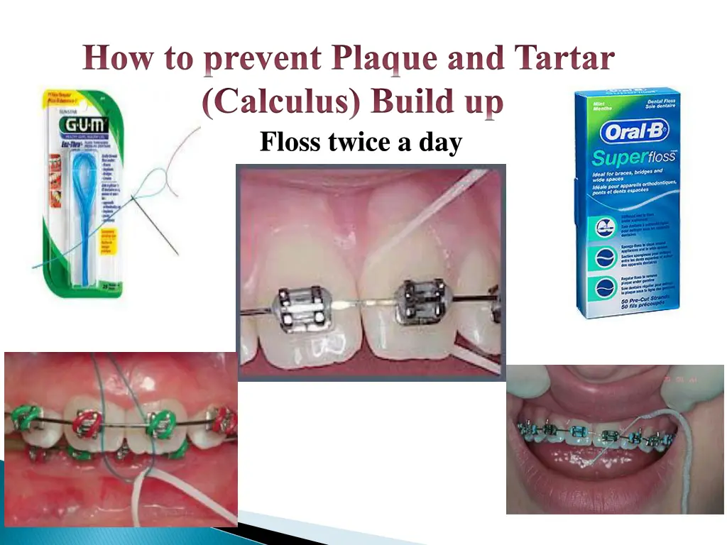 how to prevent plaque and tartar calculus build 1