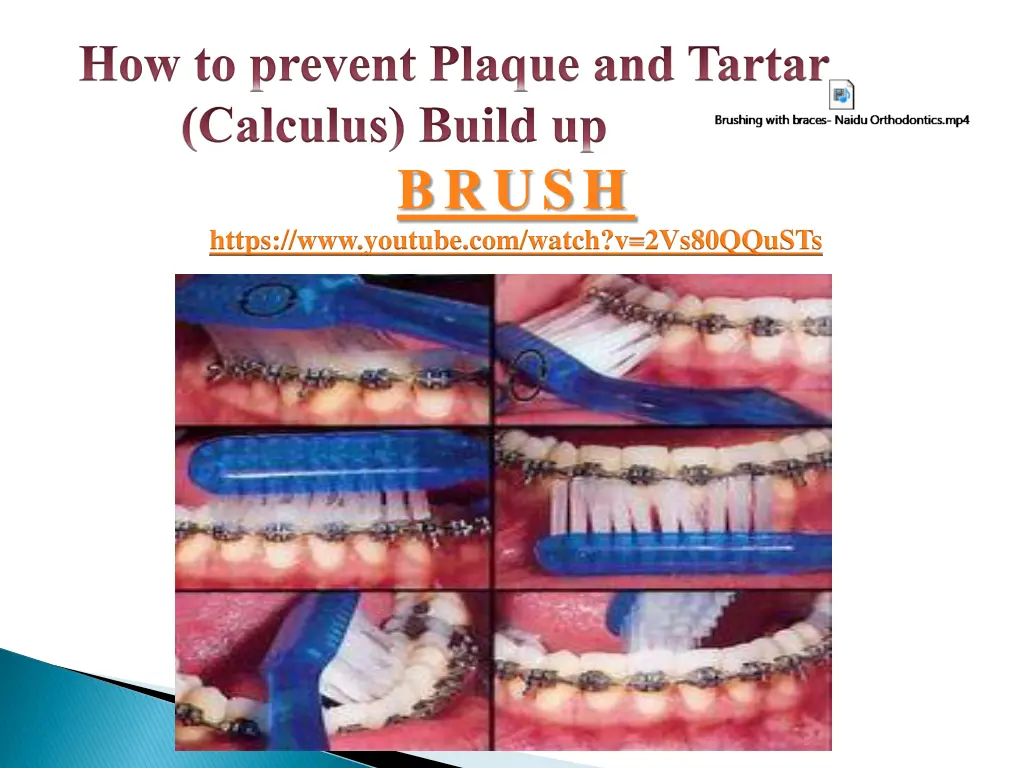 how to prevent plaque and tartar calculus build