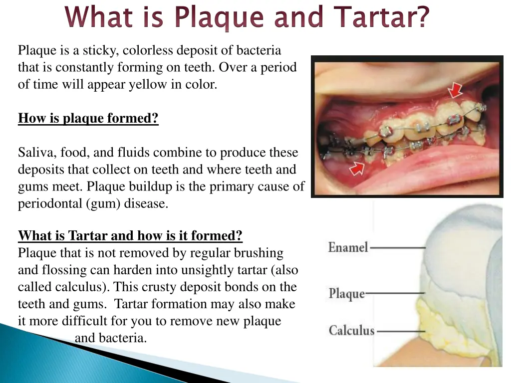 what is plaque and tartar plaque is a sticky