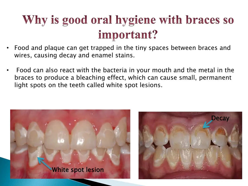 why is good oral hygiene with braces so important
