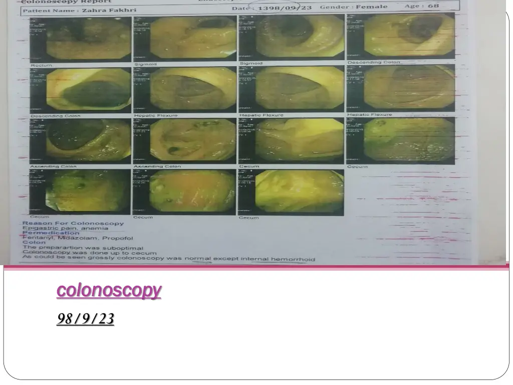 colonoscopy colonoscopy