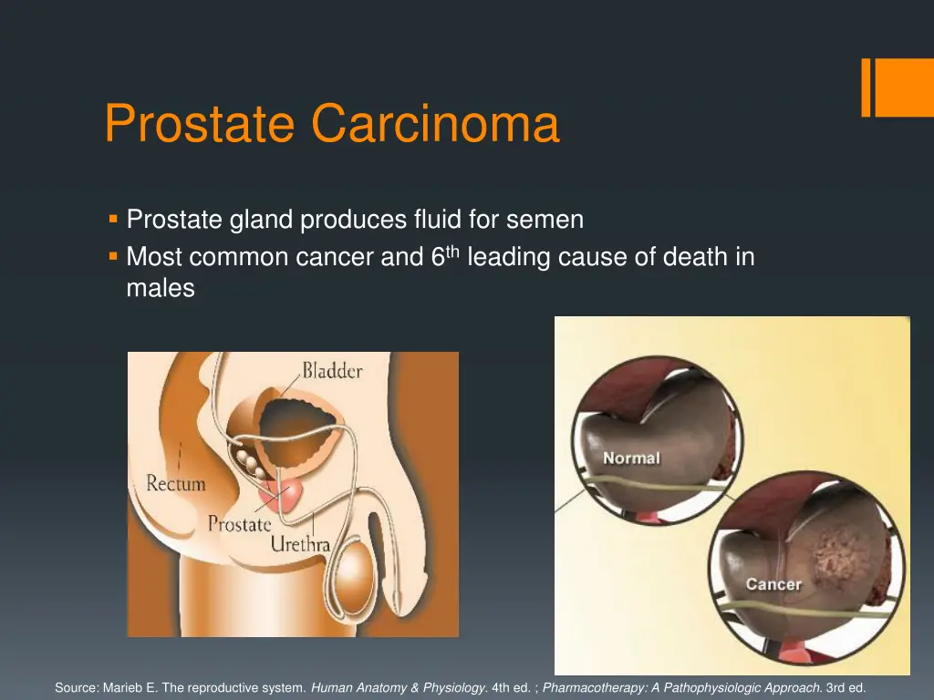 prostate carcinoma