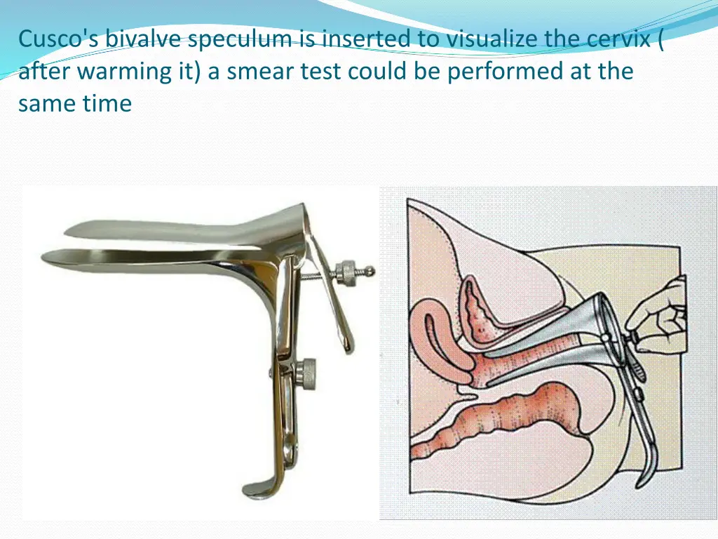 cusco s bivalve speculum is inserted to visualize