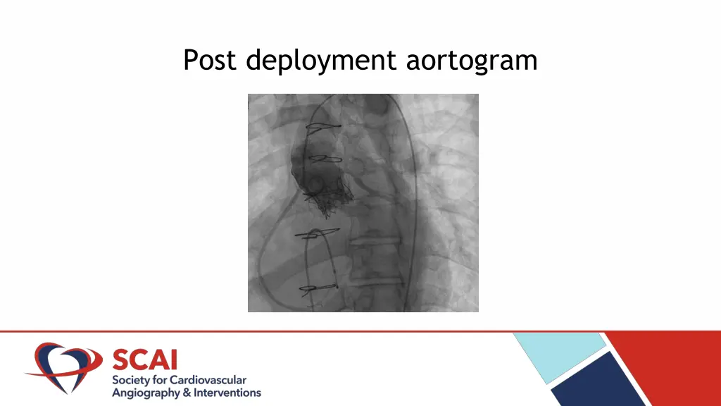 post deployment aortogram